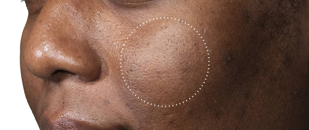 (Before): Close-up of a person’s cheek showing uneven skin texture and visible pores before using C-Tetra Advanced, with a dotted circle highlighting the area of concern.