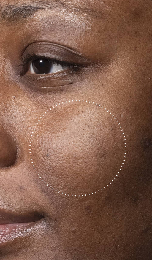 (Before): Close-up of a person’s cheek showing uneven skin texture and visible pores before using C-Tetra Advanced, with a dotted circle highlighting the area of concern.
