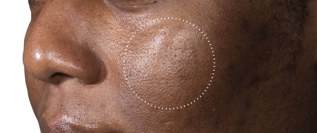 (Before): Close-up of a person’s cheek showing uneven skin texture and visible pores before using C-Tetra Advanced, with a dotted circle highlighting the area of concern.