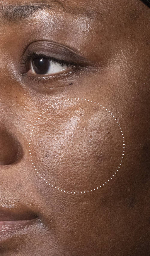 (Before): Close-up of a person’s cheek showing uneven skin texture and visible pores before using C-Tetra Advanced, with a dotted circle highlighting the area of concern.