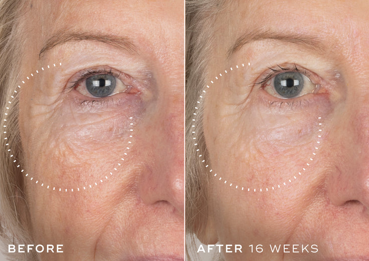 B&A comparison of a woman's eye area with visible aging signs, showing a reduction over 16 weeks of using Crystal Retinal
