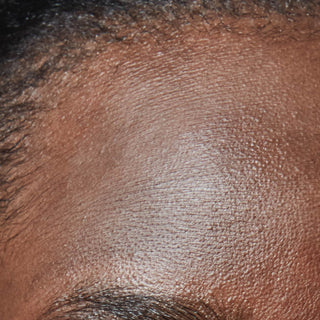 A close-up photograph illustrating the textured appearance of dry and dehydrated skin on a person's forehead. Below the image, clear text identifies this skin concern as 'Dry & Dehydrated Skin'.