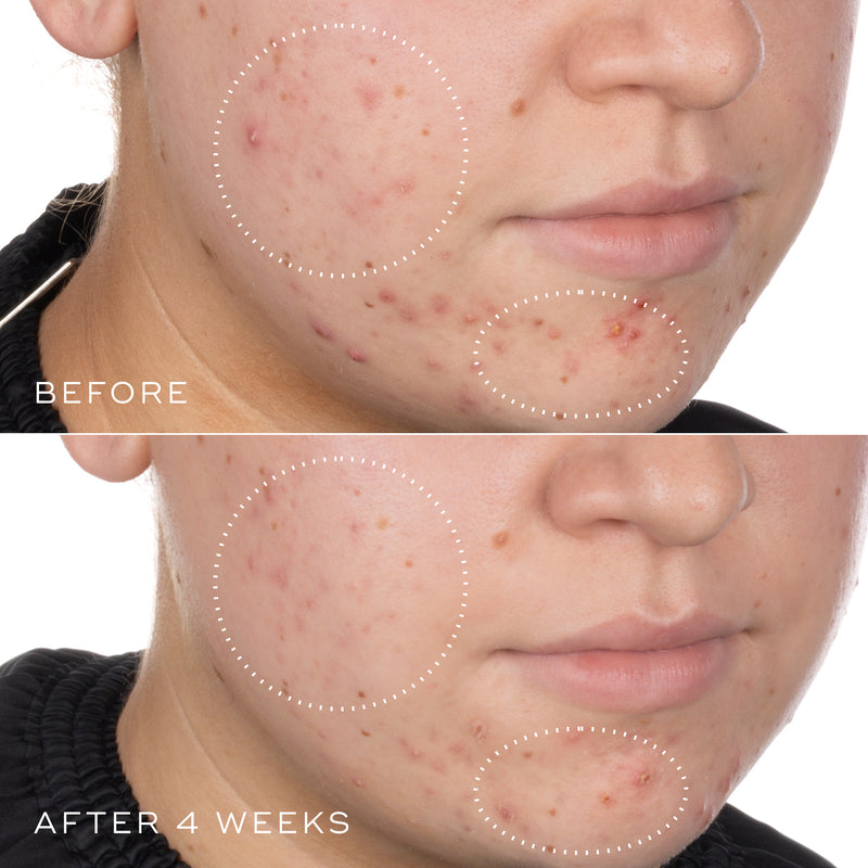 Before and after comparison of a person's face with visible skin improvement over 4 weeks of using Niacinamide Peptides
