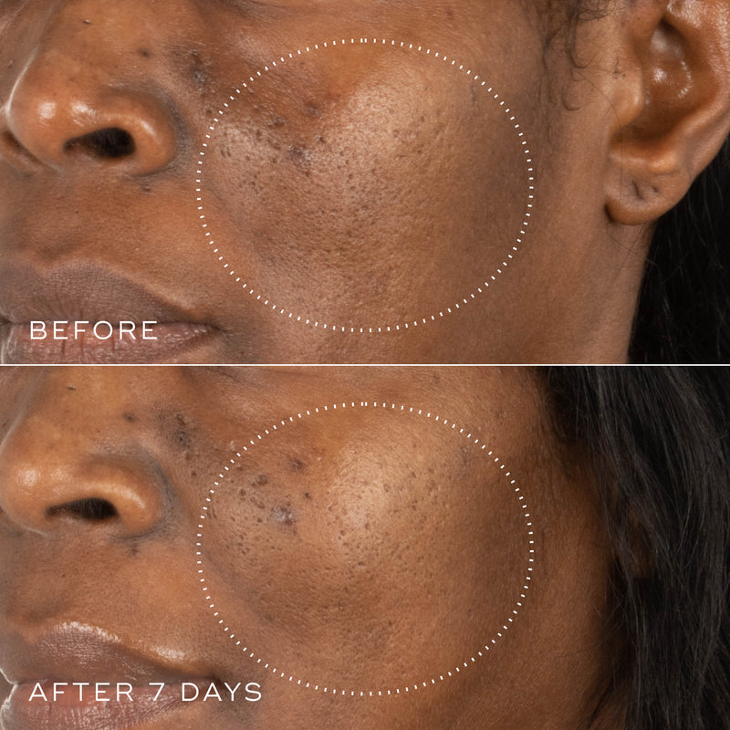 Before and after comparison of a person's face with visible skin improvement over 7 days of using Niacinamide Peptides