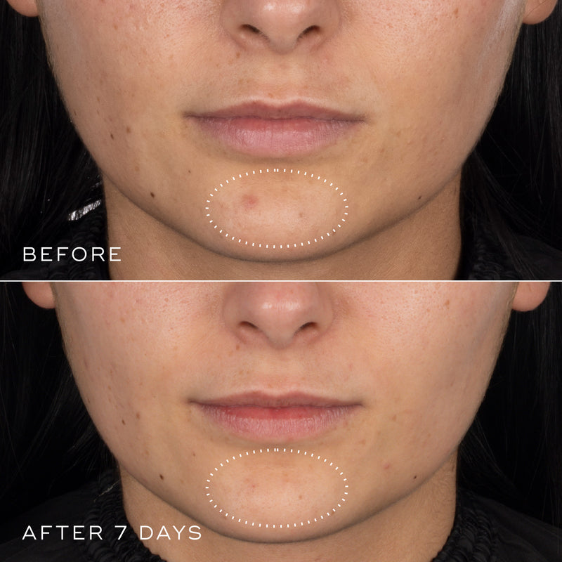 Before and after comparison of a person's face with visible skin improvement over 7 days of using Niacinamide Peptides