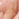 Hyperpigmentation