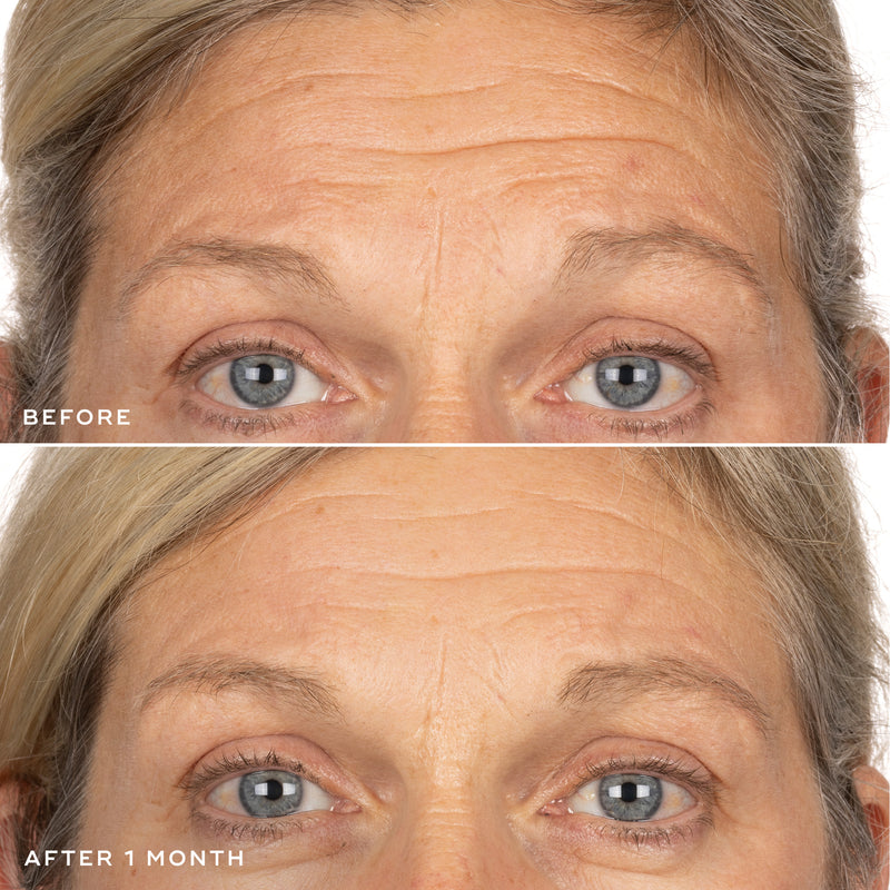 Exo-PDRN Prismatic+ Before & After 1 month